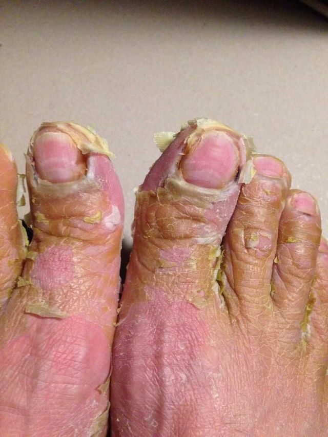 脚指甲银屑病图片图片